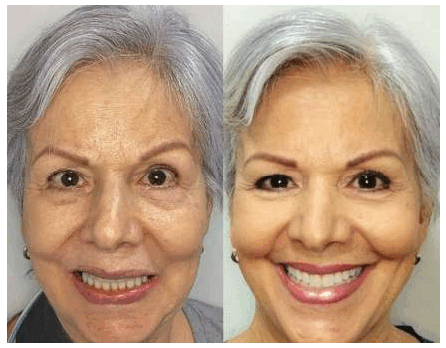 Antes y después
