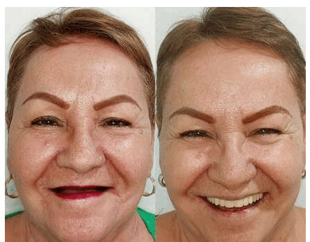 Antes y después